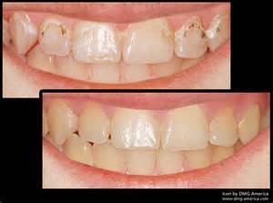 Icon Caries Infiltration Before & After