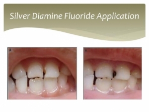 Silver Diamine Fluoride Application | FADC